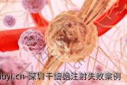 深圳干细胞注射失败案例