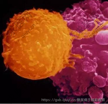糖尿病干细胞教育