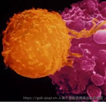 人体干细胞调理脑出血后遗症